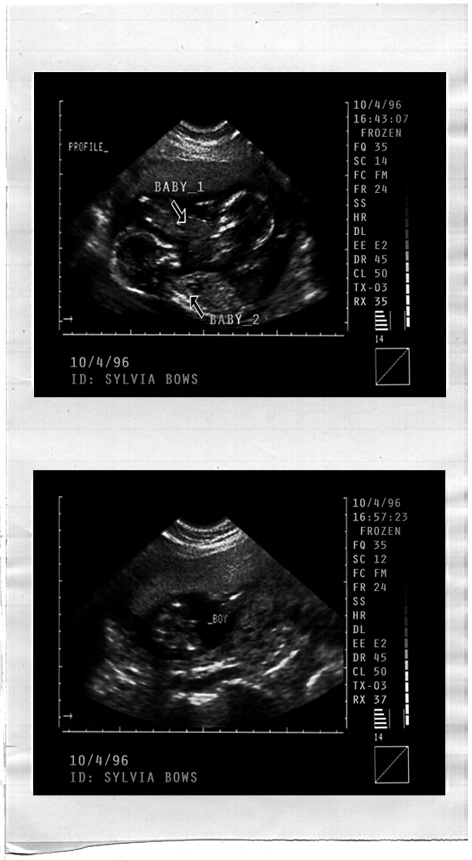 Throughout her pregnancy, Sylvia Bows shares the images of her unborn twins with Doctor Balis.